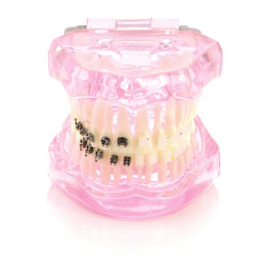 Modèle avec brackets céramiques et métalliques