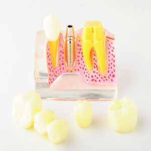 Modèle avec implants et bridges