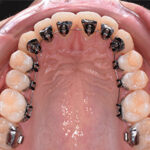 materiel orthodontique brackets fils accessoires dentaires