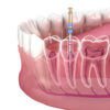 matériel endodontie dentiste limes gutta irrigation