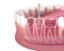 matériel endodontie dentiste limes gutta irrigation