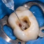 irrigation-endodontique-canal-radiculaire